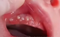 消毒险酿致命错！2个月宝宝被奶奶擦碘伏进ICU ！