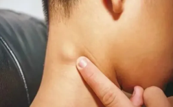5岁男孩脖子长小疙瘩确诊癌症晚期 医生提醒 ！