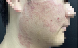 宁波小伙拿擦脚巾擦脸 结果脚气上脸！专家：有人闻臭袜肺部感染 !