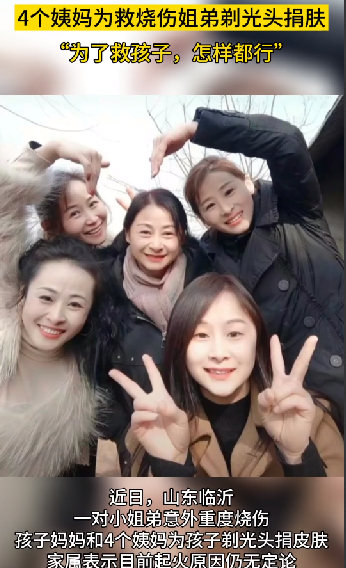 姐弟烧伤：四位姨妈剃光头捐头皮 ！-图1